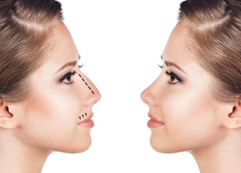 Các cách khắc phục mũi gồ