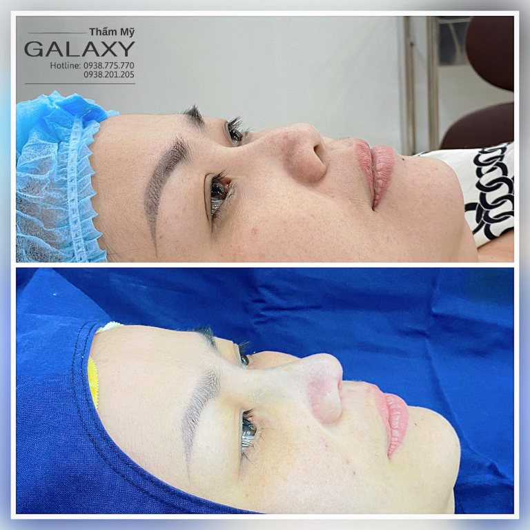 Thẩm mỹ Galaxy Dr Duy - Địa chỉ sửa mũi gồ uy tín, giá tốt