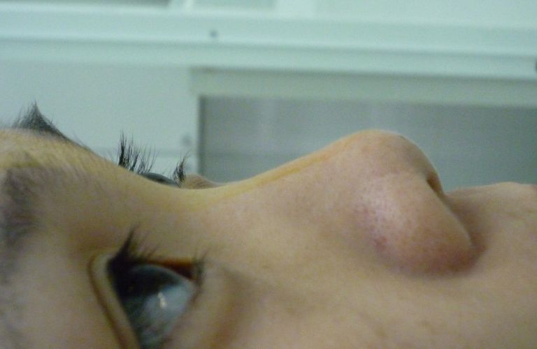 Mũi hếch khiến khuôn mặt mất đi vẻ hài hòa