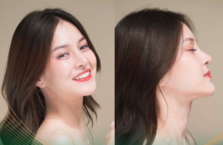 Nâng mũi cấu trúc – Giải pháp tối ưu sửa mũi hếch toàn diện