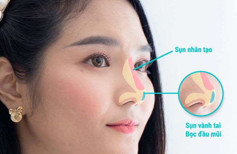 Ghép sụn tai kết hợp sụn nhân tạo