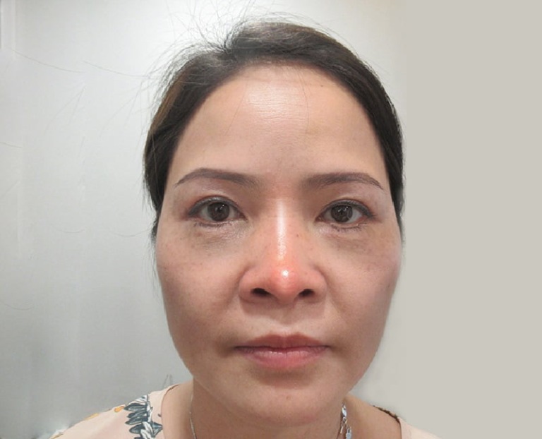 nâng mũi 1 tháng vẫn sưng