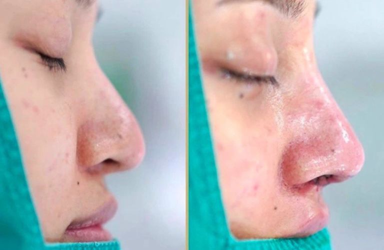 Tình trạng sưng và bầm tím rõ rệt trong giai đoạn đầu