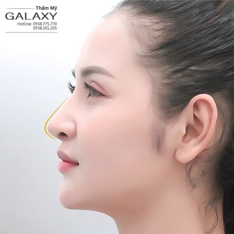 Nâng mũi bán cấu trúc là gì