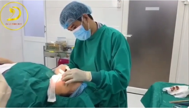 Nâng mũi bán cấu trúc có vĩnh viễn không