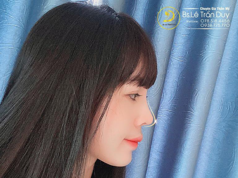 Sửa mũi bao lâu thì hết sưng
