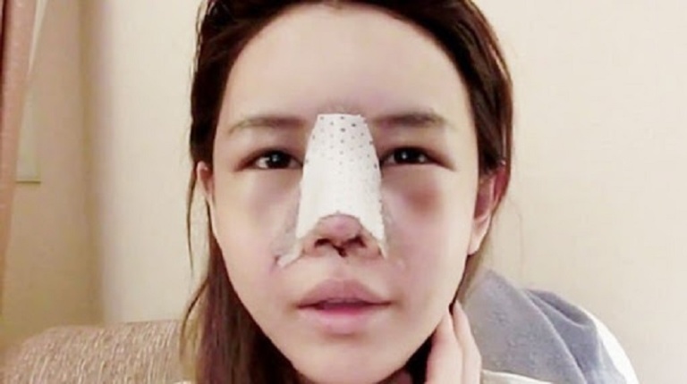 Sau nâng mũi bao lâu hết sưng