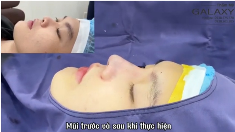 bác sĩ Lê Trần Duy tư vấn nâng mũi bao lâu hết sưng