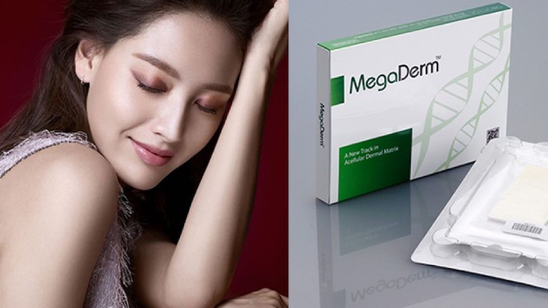 Nâng mũi cấu trúc bọc Megaderm