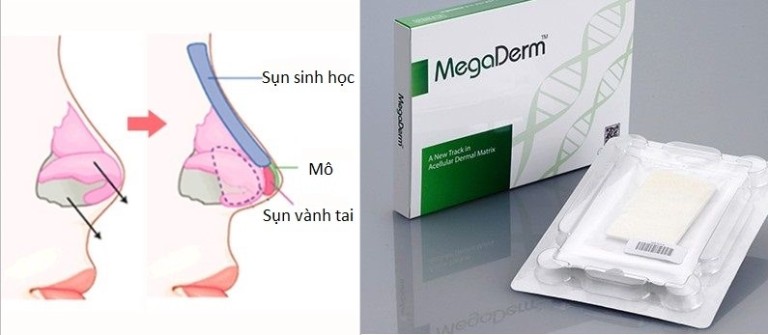 Nâng mũi cấu trúc bọc sụn Megaderm
