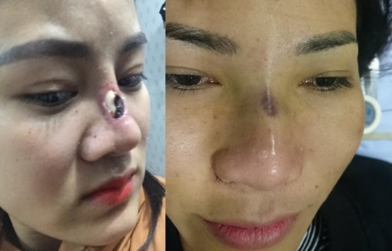 Biến chứng của nâng mũi cấu trúc bọc Megaderm