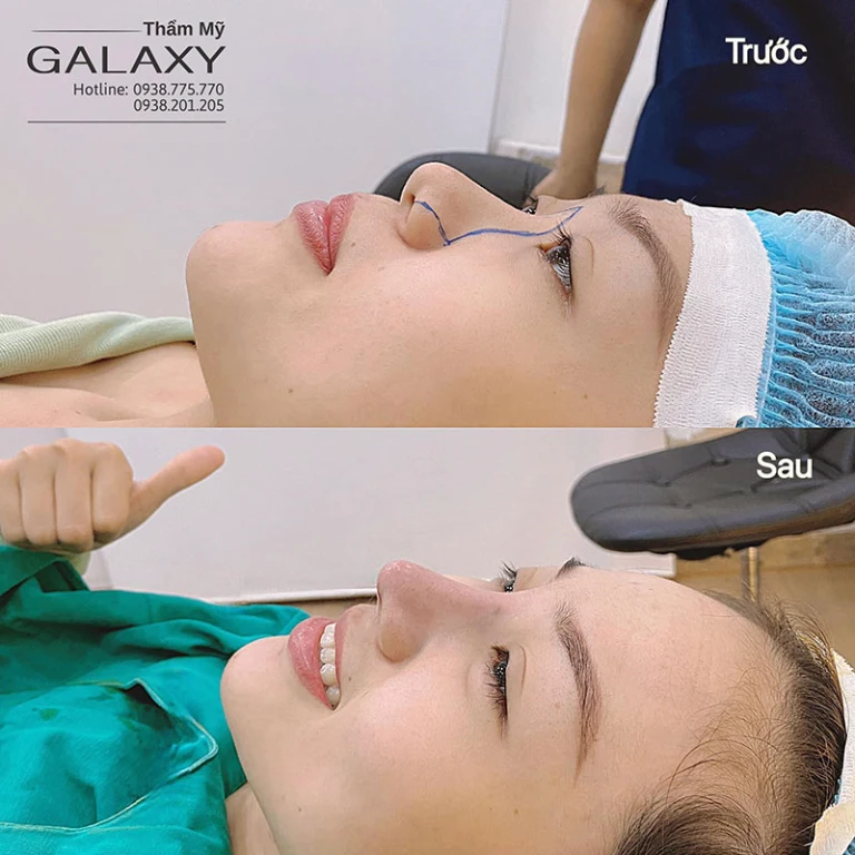 Nâng mũi cấu trúc bọc Megaderm tại Thẩm mỹ Galaxy