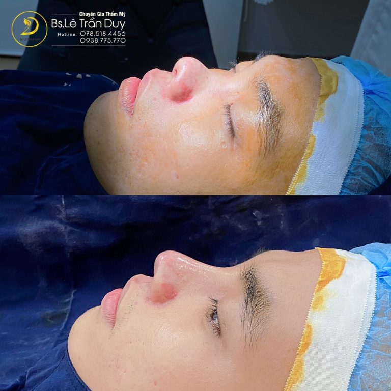 Thẩm mỹ bác sĩ Lê Trần Duy - Địa chỉ nâng mũi cấu trúc Pureform uy tín tại TPHCM