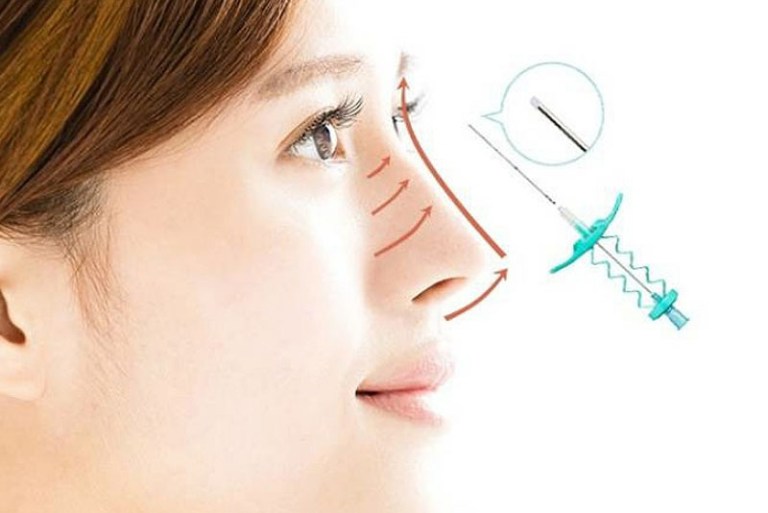 Nâng mũi bằng chỉ Collagen là gì