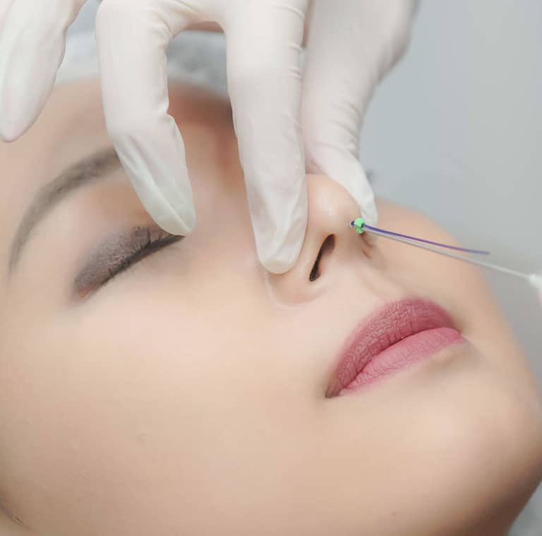 Nâng mũi bằng chỉ Collagen có an toàn không