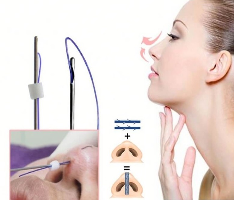 Quy trình nâng mũi bằng chỉ Collagen