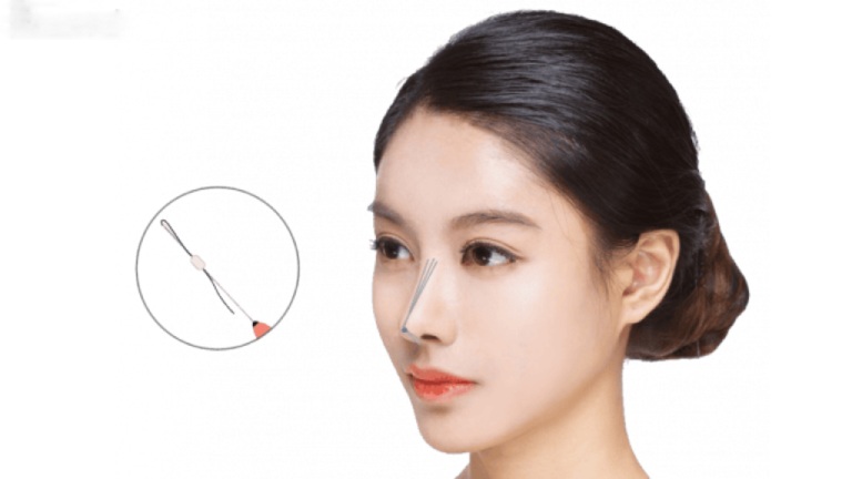 Nâng mũi bằng chỉ Collagen được bao lâu