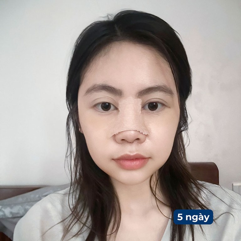Nâng mũi xong có đau không