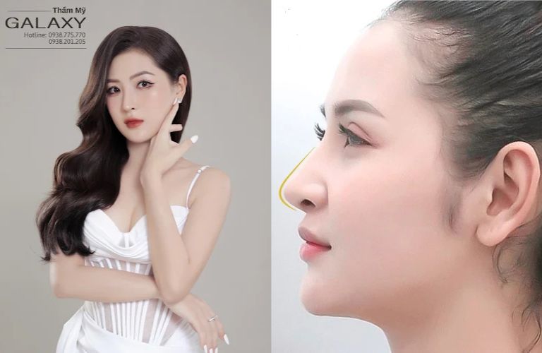Nâng mũi cao Tây