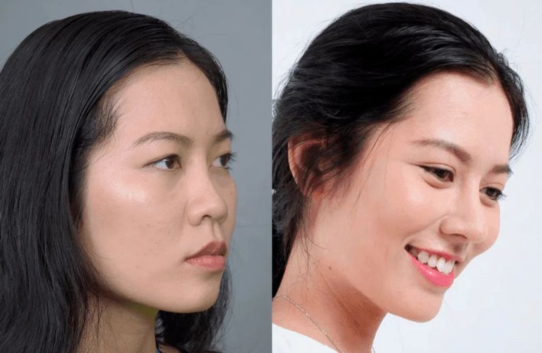 Phương pháp nâng mũi cao Tây phù hợp với những người có dáng mũi thấp, tẹt