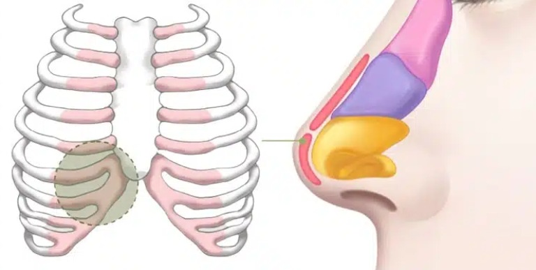 nâng mũi dáng tự nhiên bằng sụn sườn