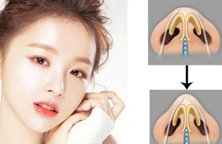 Nâng mũi dựng trụ