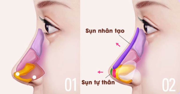 Nhược điểm của nâng mũi Ergonomic
