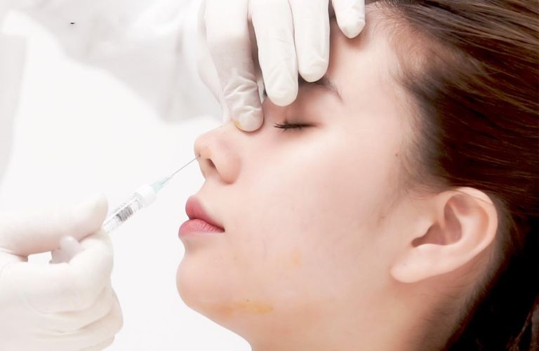 Nâng mũi bằng filler không phải là phương pháp vĩnh viễn