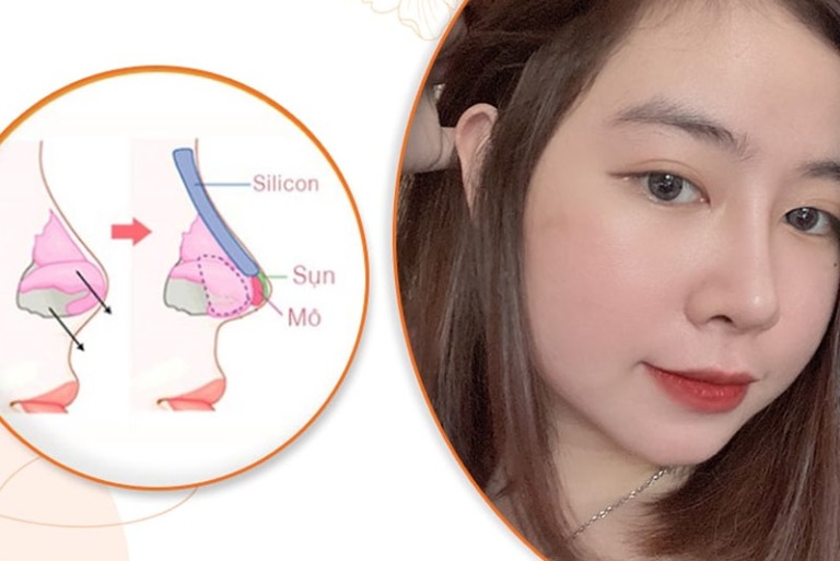 Nâng mũi bọc sụn giữ được bao lâu?