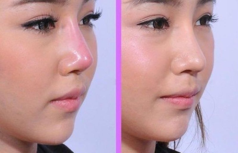 biến chứng nâng mũi Implant