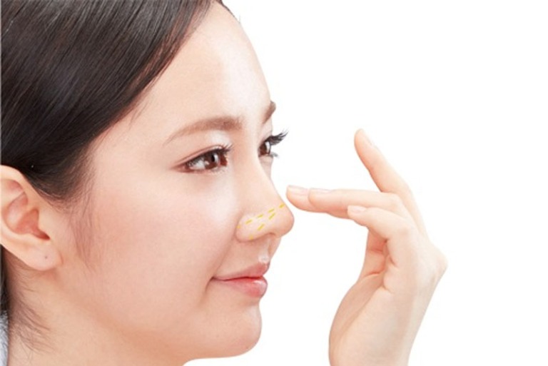 nâng mũi khắc chạm là gì