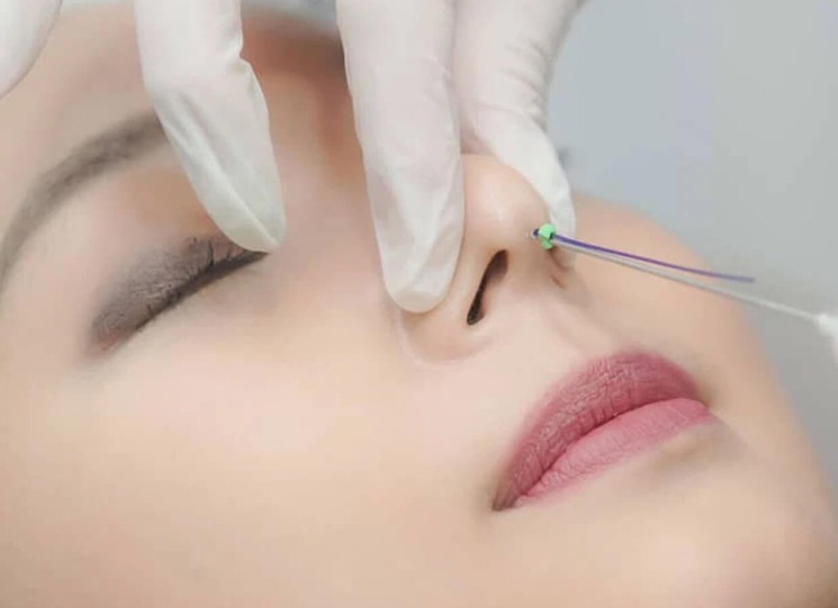 Nâng mũi chỉ là tiểu phẫu hay đại phẫu