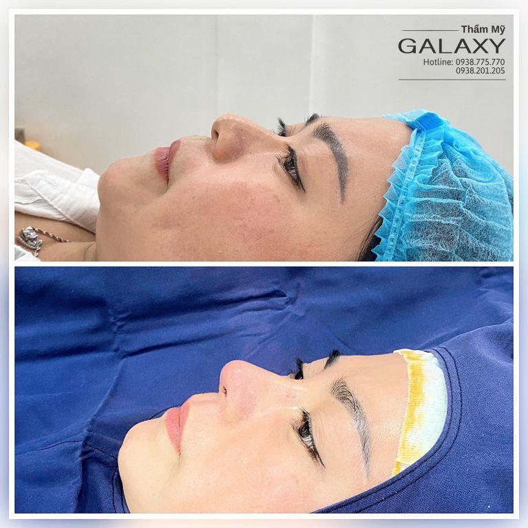 nâng mũi tiểu phẫu và đại phẫu an toàn tại Thẩm mỹ Galaxy