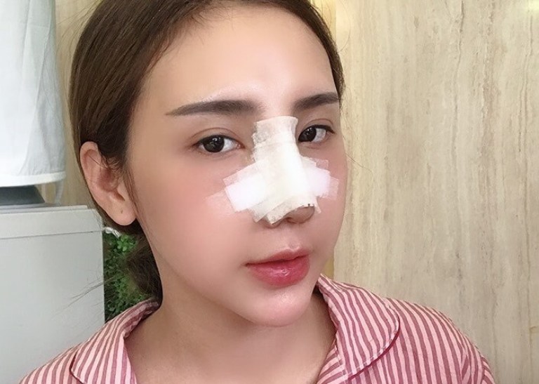 Nâng mũi mấy ngày tháo nẹp?
