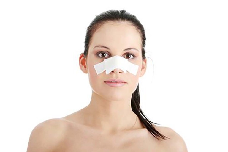 sau khi nâng mũi mấy ngày thì tháo nẹp
