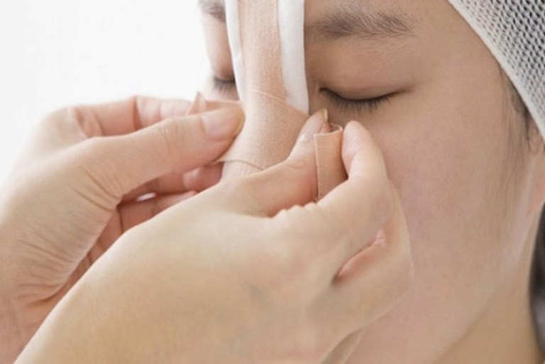 nâng mũi sau bao lâu thì tháo nẹp
