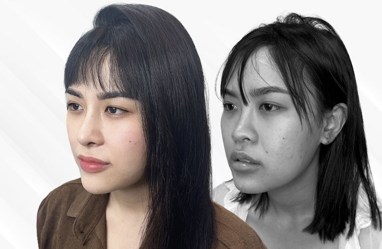 Nâng mũi ở Đài Loan giá bao nhiêu?