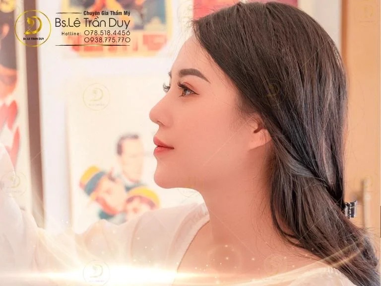 Nâng mũi Queen Form ở thẩm mỹ Bác sĩ Lê Trần Duy