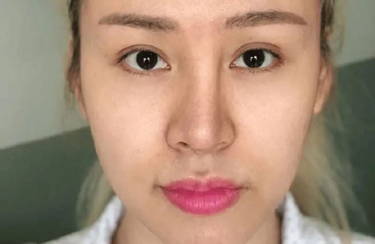 Việc tiêm filler lên trên hoặc gần sụn có thể làm hỏng kết quả nâng mũi hoặc làm lệch dáng mũi