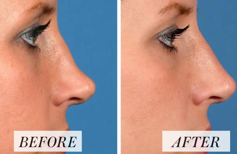 Chỉ tiêm filler sau phẫu thuật nâng mũi ít nhất 6 - 12 tháng