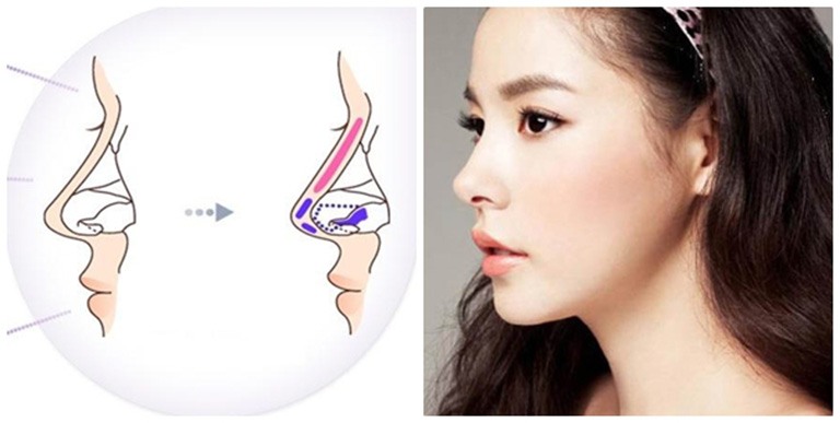 Chi phí nâng mũi S Line 2 lớp