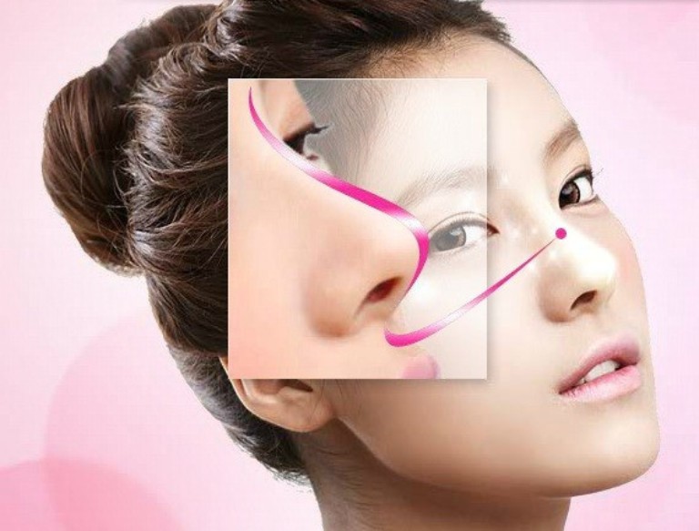 Nâng mũi S Line Plus là gì