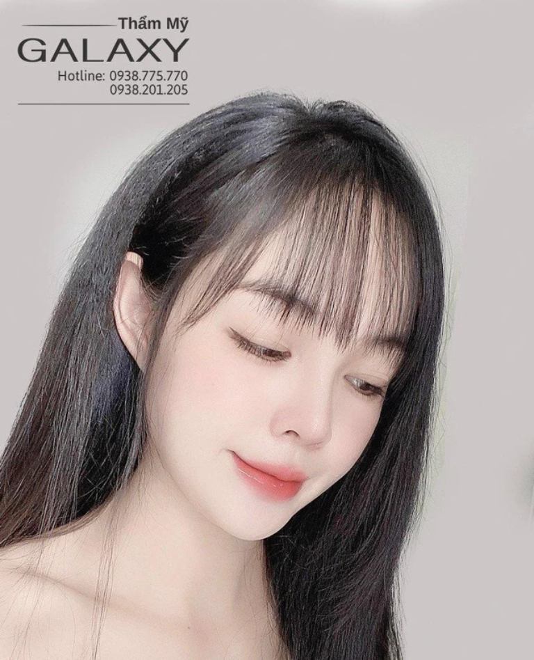 nâng mũi sau 1 tháng
