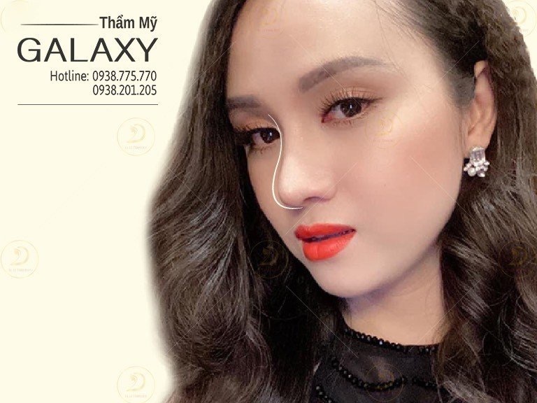 Nâng mũi sau 1 tháng đã đẹp chưa
