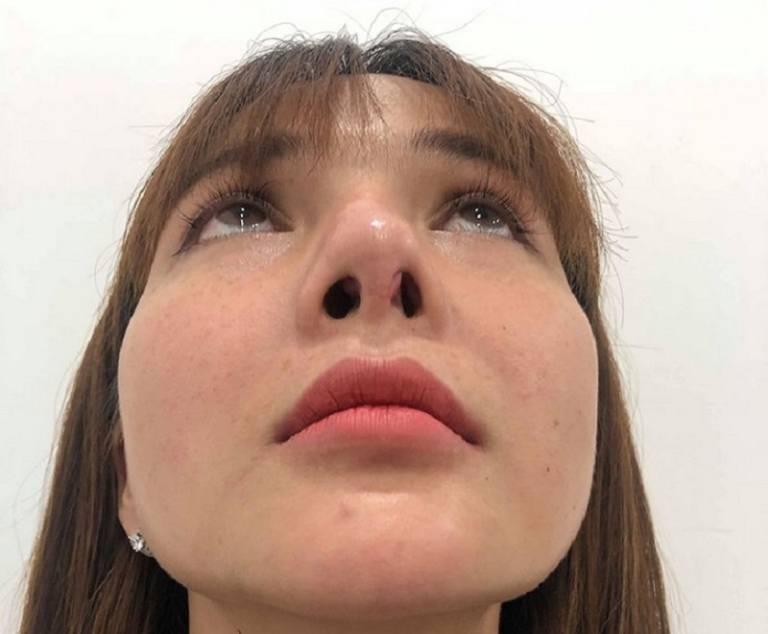 nâng mũi 10 ngày vẫn sưng