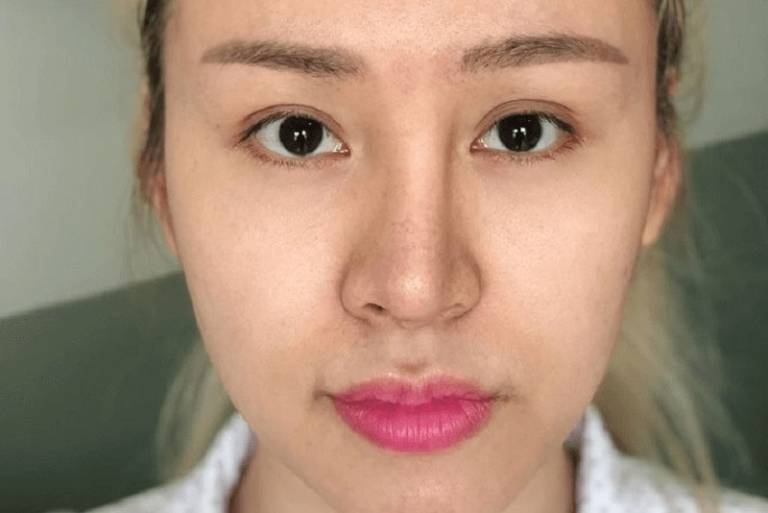 Nâng mũi 10 ngày bị lệch