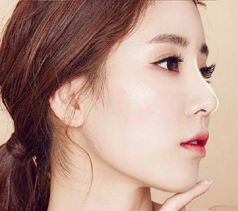 quá trình phục hồi nâng mũi sau 10 ngày