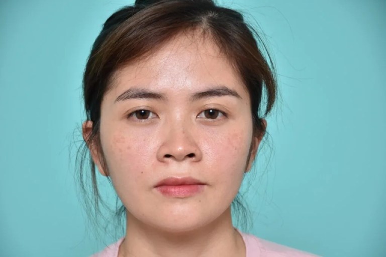 Có nên nâng mũi siêu cấu trúc không