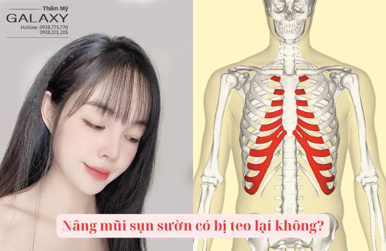 Nâng mũi sụn sườn có bị teo lại không