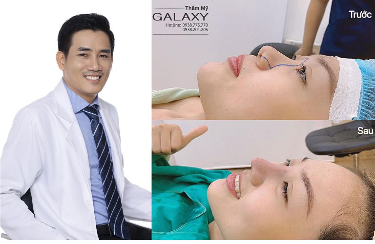 Bác sĩ Lê Trần Duy: Chuyên gia nâng mũi sụn sườn uy tín